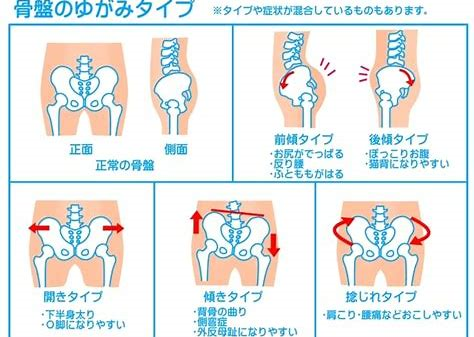 骨盤のゆがみ
